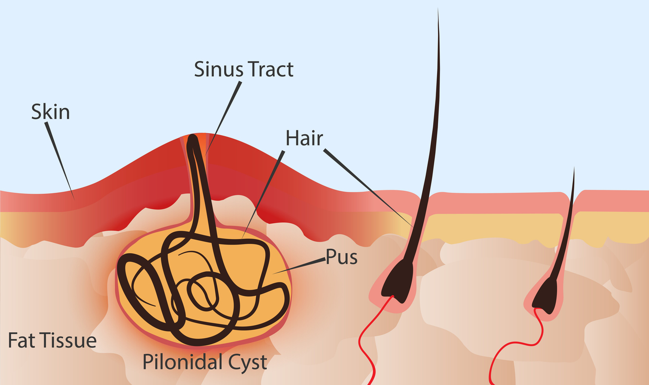 pilonidal cyst doctor