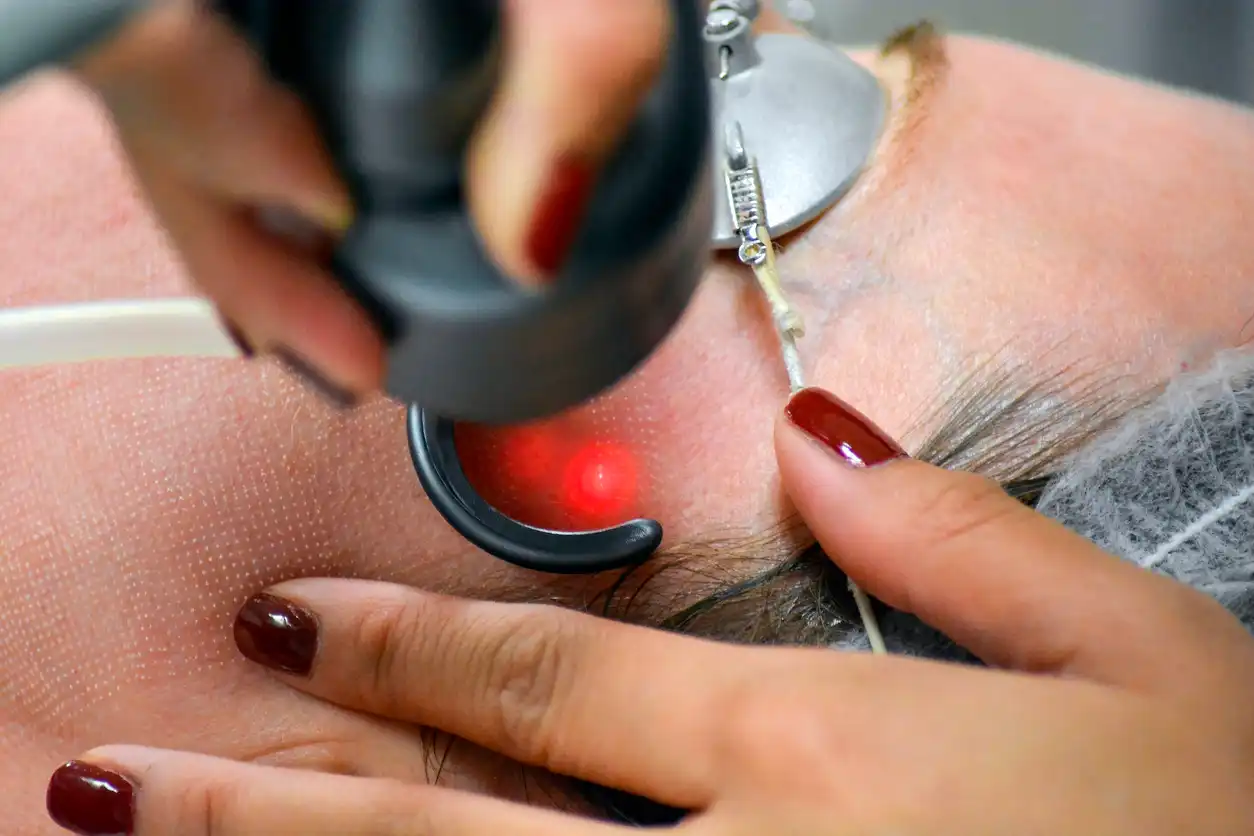 Laser Therapy and Conventional Surgery