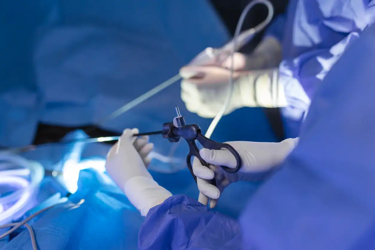 Minimally Invasive Treatment of Pilonidal Cysts