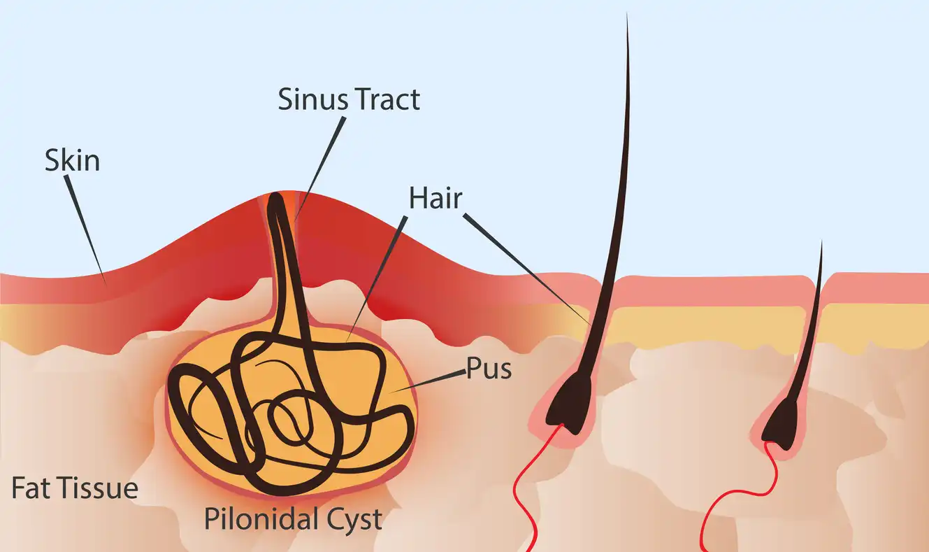 What Is a Pilonidal Cyst